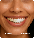 SmileStrips™ – Fitas Clareadoras de Alta Performance (Compre 1 Ganhe 35)