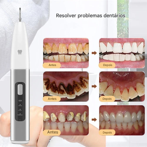 DentClean Pro™ – Removedor Elétrico de Tártaro e Manchas Dentais