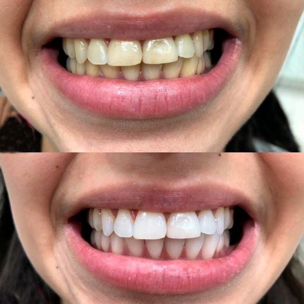HiSmile™ – Creme Dental Clareador Instantâneo!