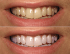 HiSmile™ – Creme Dental Clareador Instantâneo!