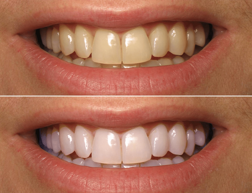 HiSmile™ – Creme Dental Clareador Instantâneo!